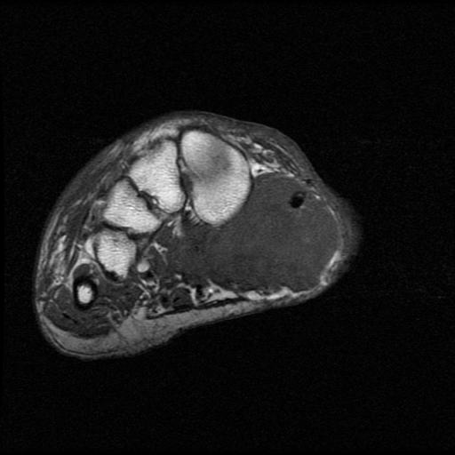 Soft tissue sarcoma medial foot